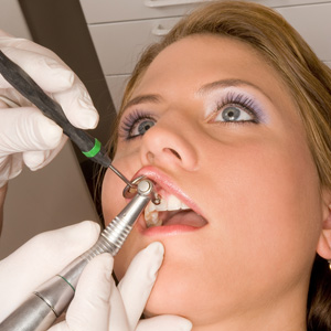 Parodontoza, dinti, dentist, detartraj, tratament