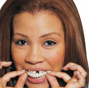 Snap-On Smile